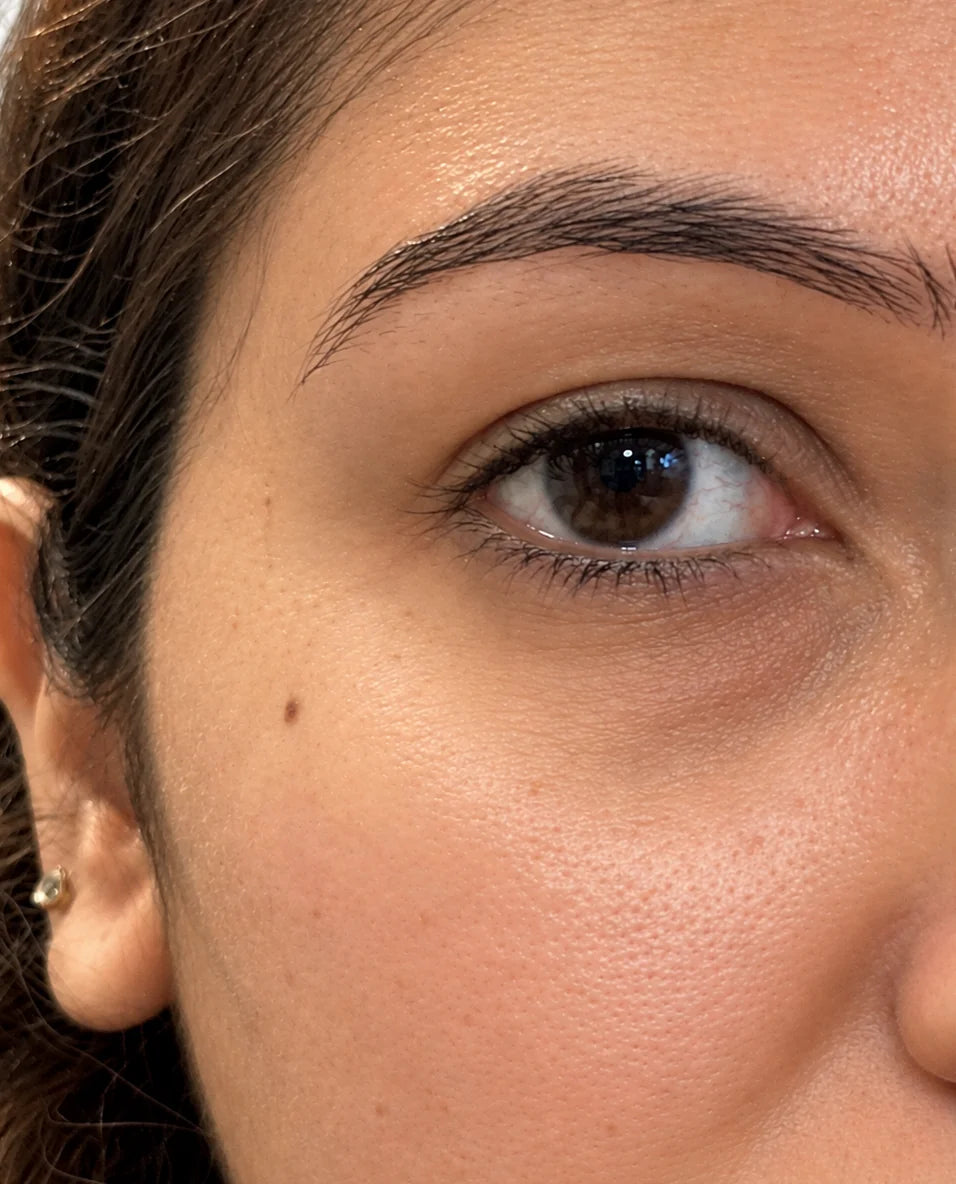 Dark circles & puffiness