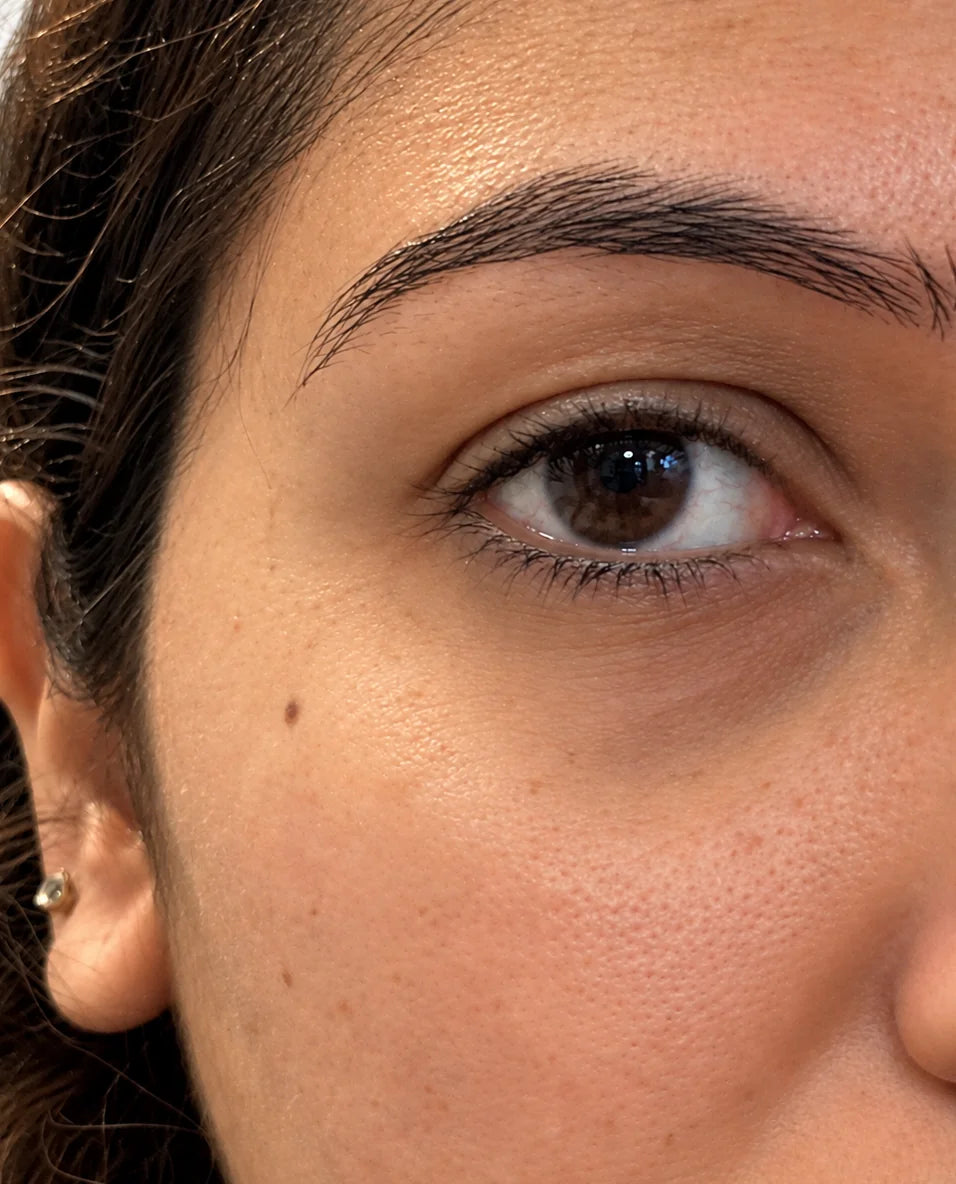 Dark circles & puffiness